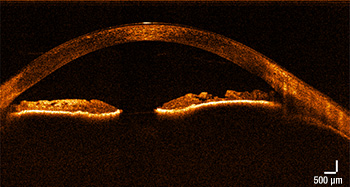 SL13 OCT Anterior Eye